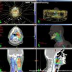 radiotherapy treatment planning