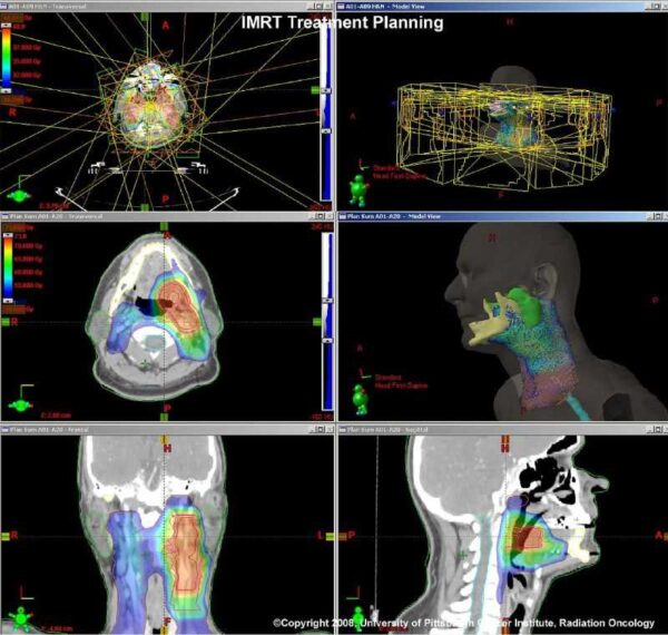 radiotherapy treatment planning