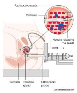 Injection of radioactive capsules to treat prostate cancer