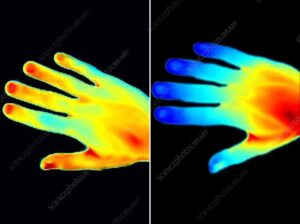 Hand thermogram of a healthy person before smoking (left) and after smoking (right)