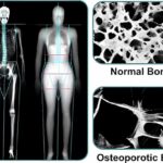 Comparison of the density of a normal bone (top) and the bone of a patient with osteoporosis (bottom)