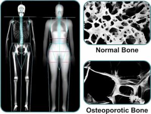 Comparison of the density of a normal bone (top) and the bone of a patient with osteoporosis (bottom)